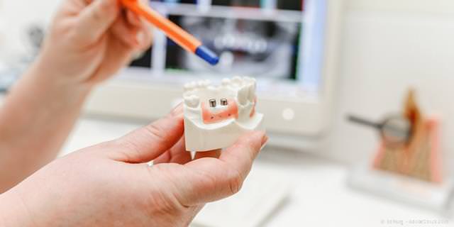 PZR bei Zahnersatz, Implantaten und Kieferorthopädie