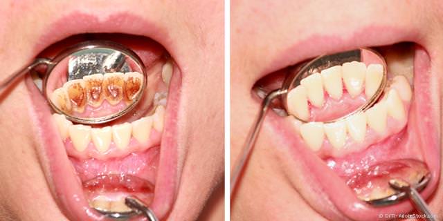 Vor und nach der Professionellen Zahnreinigung