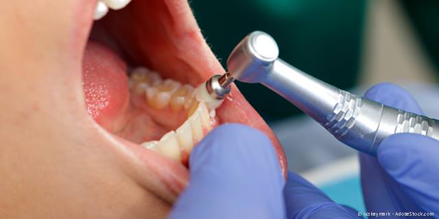 Politur der Zähne bei der PZR