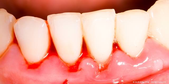 Zahnfleischentzündung mit Zahnfleischbluten bei einer Parodontitis