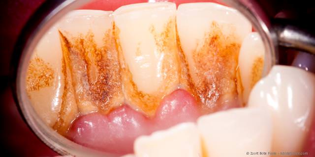 Bakterien im Zahnbelag können eine Parodontitis verursachen
